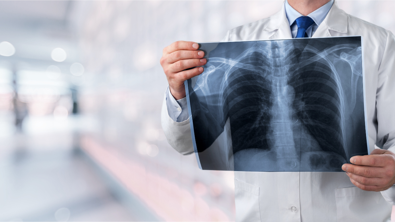 Clinical Trial of Keytruda and Lynparza Combination Fails to Meet Primary Endpoint for Treatment of Metastatic Nonsquamous Non-Small Cell Lung Cancer 