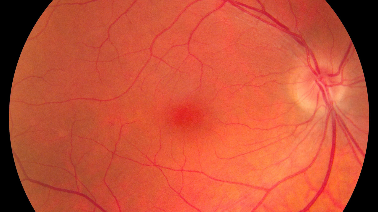  Licensed   FILE #:  318624830  Preview Crop  Find Similar DIMENSIONS 3000 x 3186px FILE TYPE JPEG CATEGORY Science LICENSE TYPE Standard or Extended Ophthalmic image detailing the retina and optic nerve inside a healthy human eye. Medicine concept. Image Credit: Adobe Stock Images/Ольга Тернавская