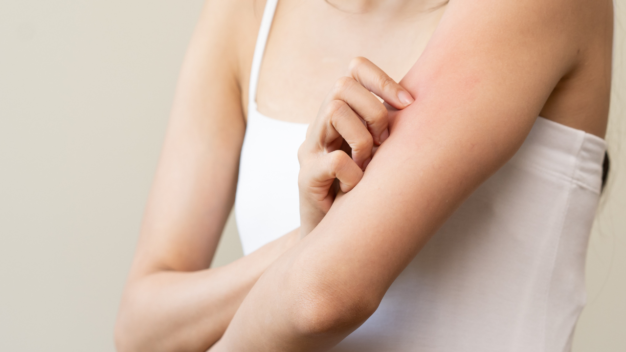 Dermatology, asian young woman reaction from atopic, insect bites on her arm, hand in scratching itchy red spot or rash of skin. Healthcare, treatment of beauty. Image Credit: Adobe Stock Images/Pormezz