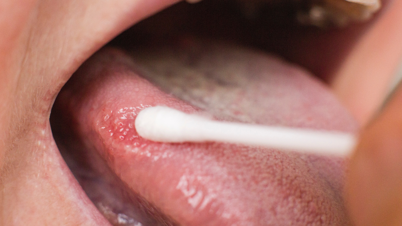 Taking a smear for a disease in the tongue of a woman. Glossitis and gingivitis tongue disease research concept, medical. Image Credit: Adobe Stock Images/HENADZY