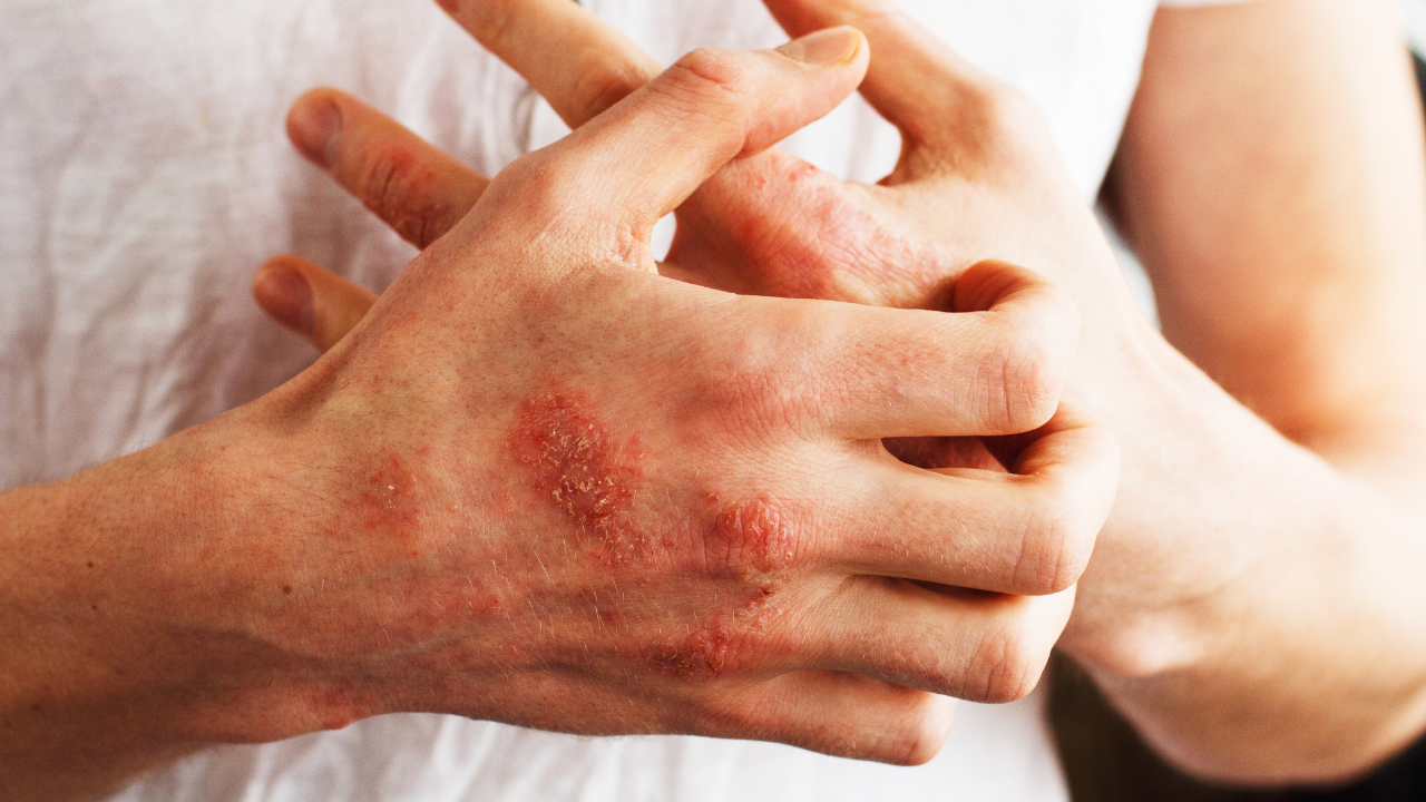 Man scratch oneself, dry flaky skin on hand with psoriasis vulgaris, eczema and other skin conditions like fungus, plaque, rash and patches. Autoimmune genetic disease. Image Credit: Adobe Stock Images/Ольга Тернавская