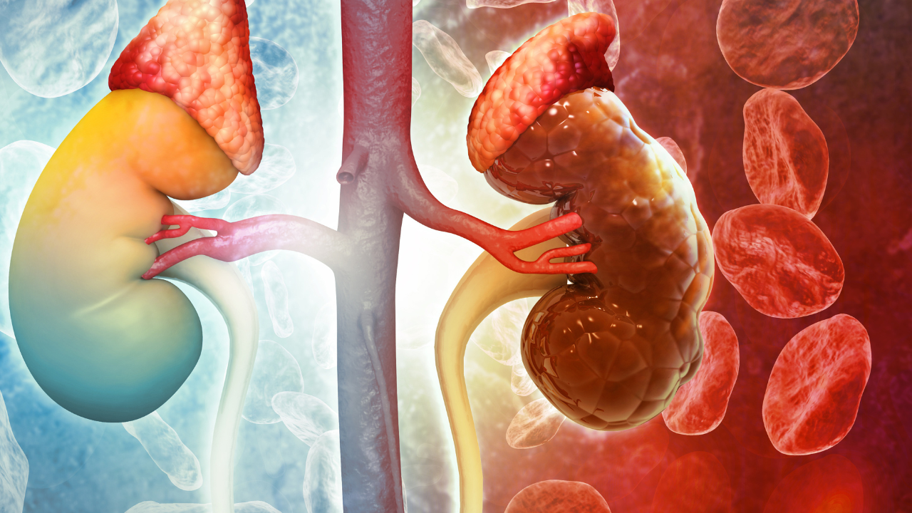 Chronic kidney disease. 3d illustration. Image Credit: Adobe Stock Images/Crystal light