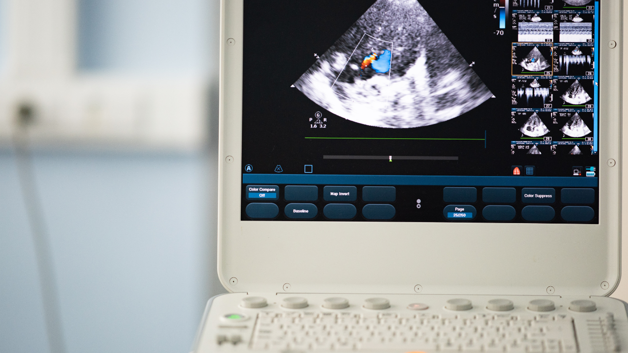 Screen of an ultrasound device with a heart scan. The Doppler method shows valve regurgitation. Image Credit: Adobe Stock Images/faustasyan