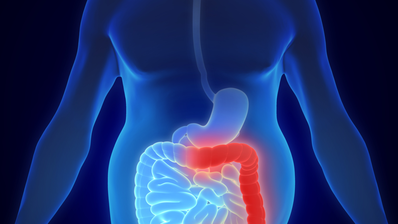 3D illustration showing Colitis ulcerosa - inflammatory bowel disease. Image Credit: Adobe Stock Images/Lars Neumann