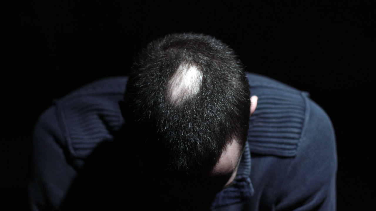Desperate Young Man Touch His Bald Patches. Image Credit: Adobe Stock Images/meyer_solutions