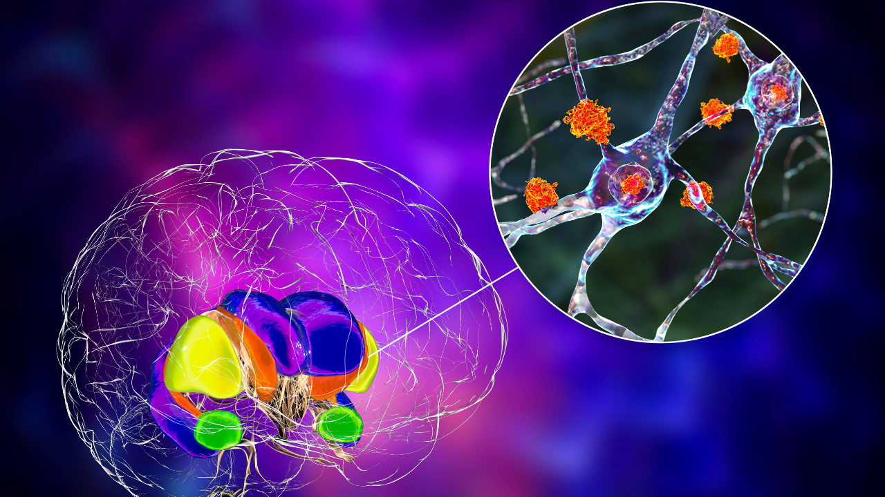 Dorsal striatum and its neurons in the Huntington's disease, 3D illustration. Image Credit: Adobe Stock Images/Dr_Microbe