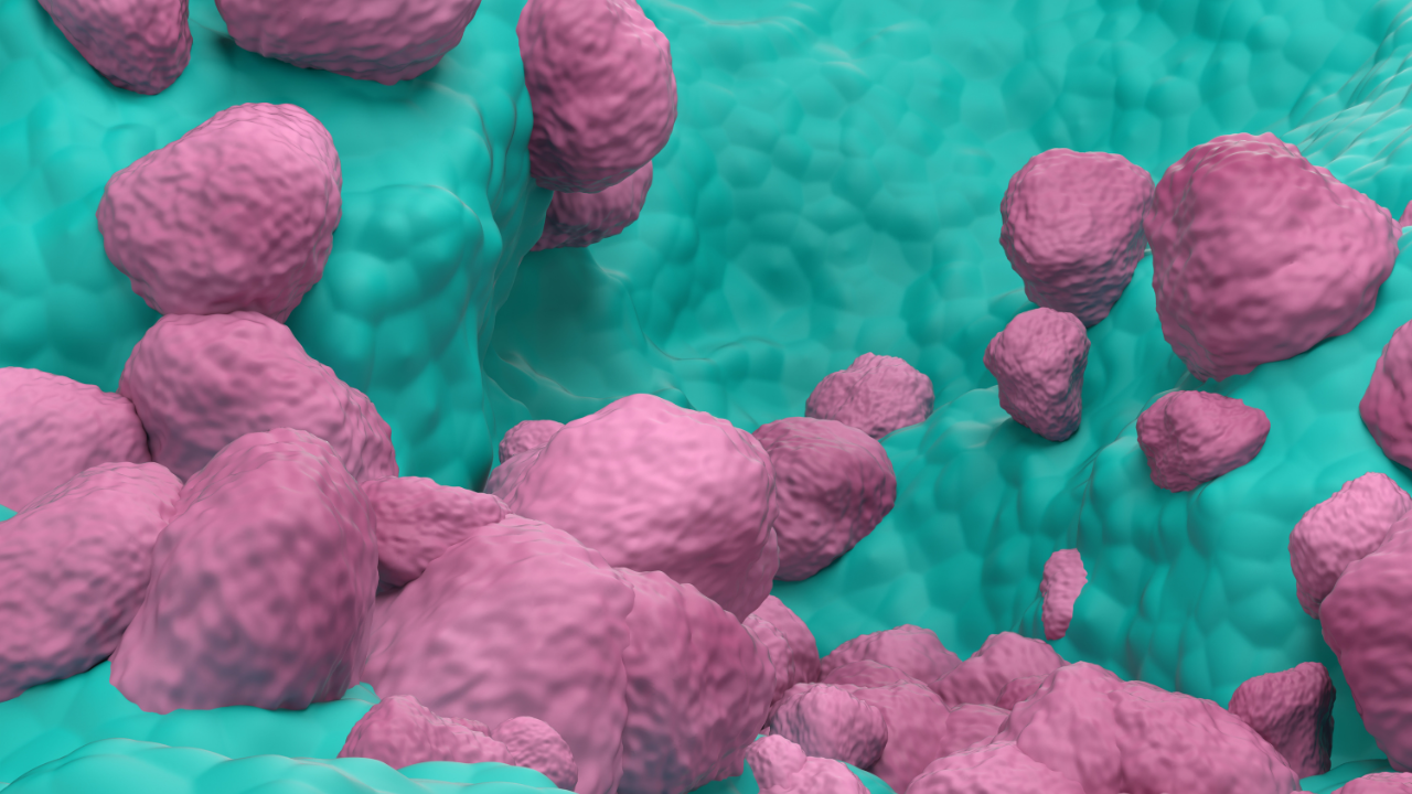 Non Small Cell Lung Cancer (NSCLC) in the lung tissue – closeup view 3d illustration. Image Credit: Adobe Stock Images/LASZLO