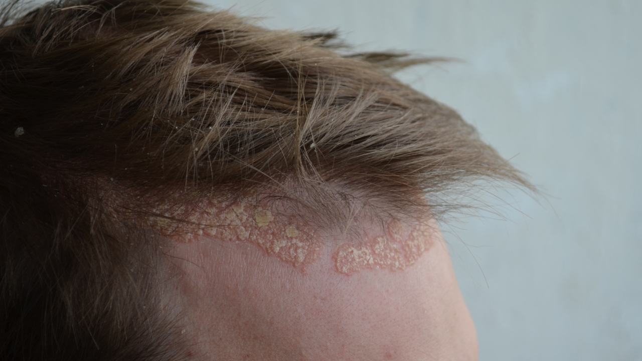 Psoriasis on the skin close-up, scalp, photos of dermatitis and eczema, skin problems, dermatology. Image Credit: Adobe Stock Images/llia