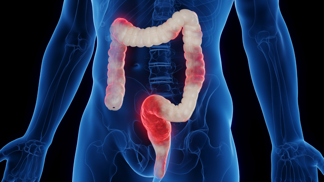 3D medical illustration of a man's inflamed colon. Image Credit: Adobe Stock Images/SciePro