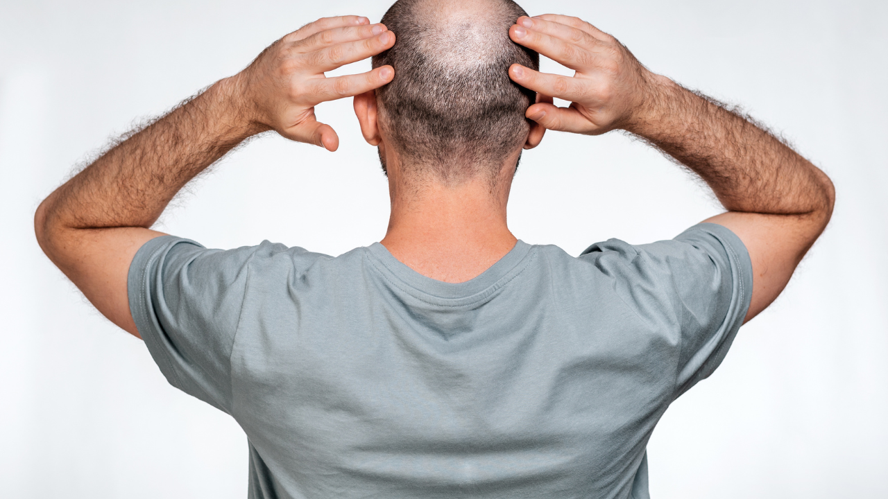 A man holds his hands over his bald head, demonstrating focal alopecia. Rear view. The concept of baldness and male alopecia. Image Credit:Adobe Stock Images/_KOBE_