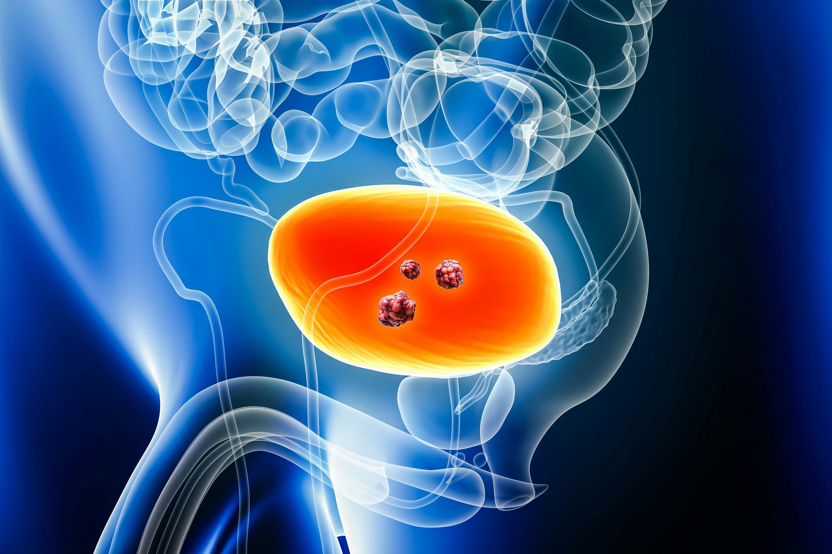Image credit: Matthieu | stock.adobe.com. Urinary bladder cancer with organs and tumors or cancerous cells 3D rendering illustration with male body. Anatomy, oncology, biomedical, disease, medical, biology, science, healthcare