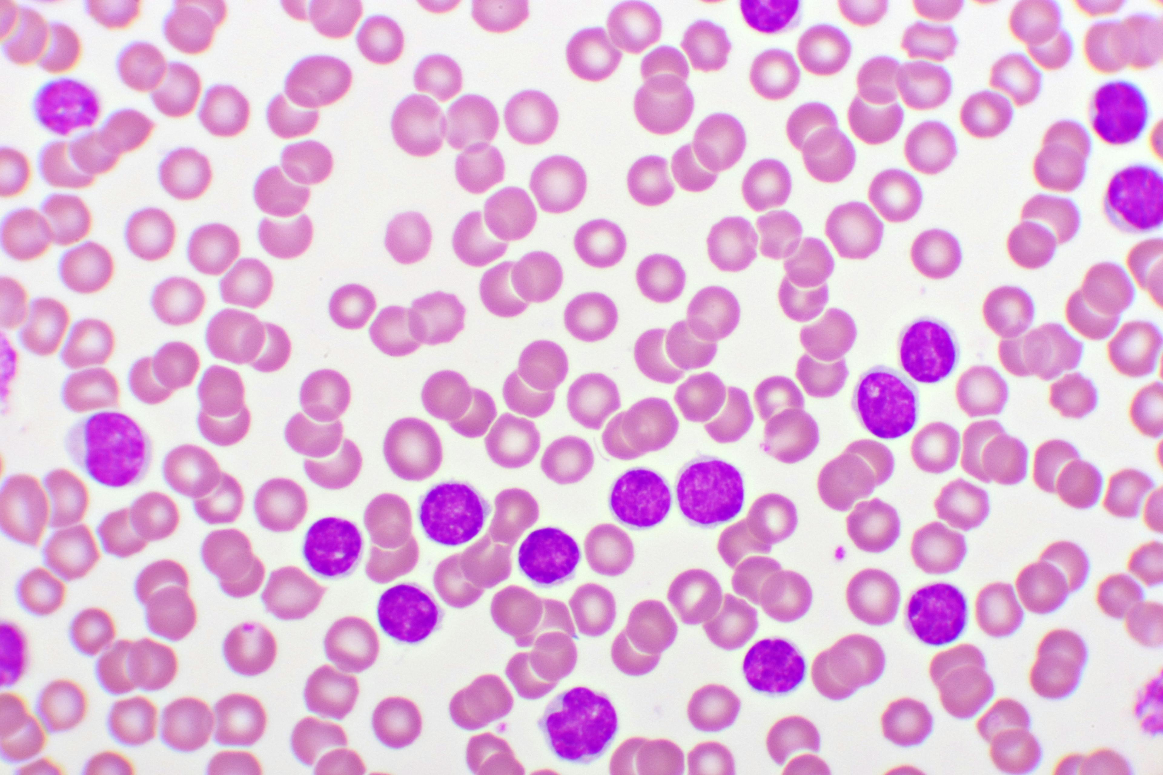 Image credit:  jarun011 | stock.adobe.com. Picture of acute lymphocytic leukemia or ALL cells in blood smear, analyze by microscope, 1000x
