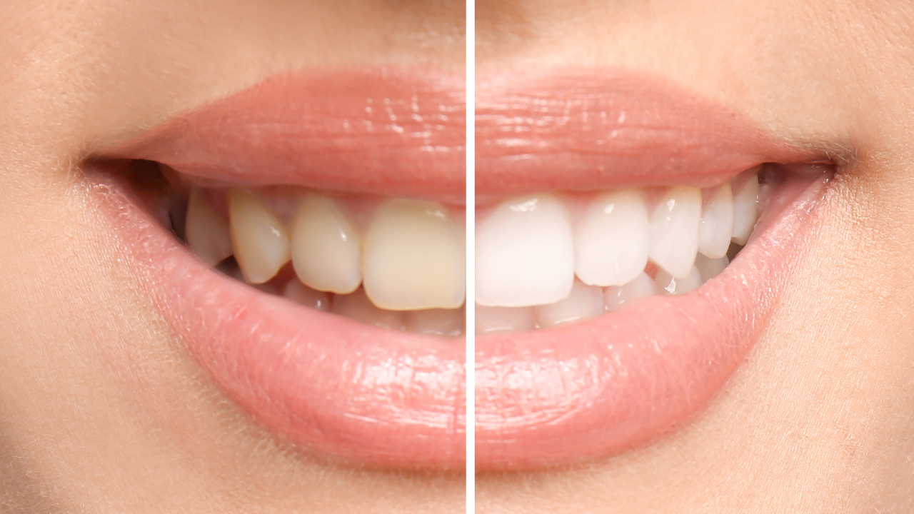 Smiling woman before and after teeth whitening procedure, closeup. Image Credit: Adobe Stock Images/New Africa