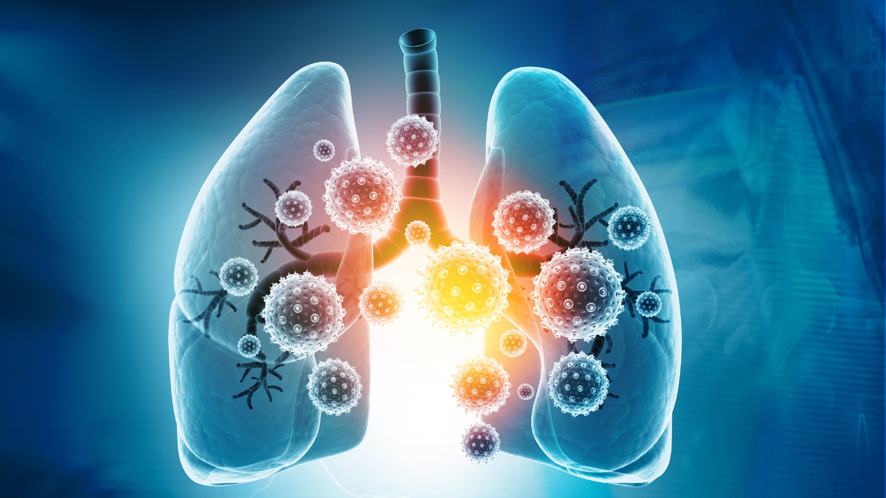 Viral lung infections, lung infection conept. 3d illustration. Image Credit: Adobe Stock Images/Rasi