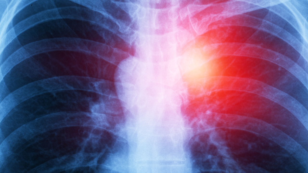 FDA Grants Priority Review to Keytruda Combination as a First-Line Treatment for Unresectable Advanced or Metastatic Malignant Pleural Mesothelioma