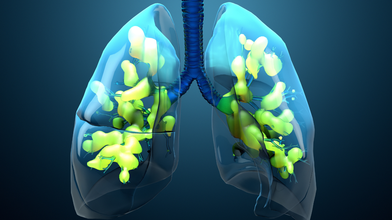 FDA Grants Fast Track Designation to AV-001 for Moderate-to-Severe Acute Respiratory Distress Syndrome 