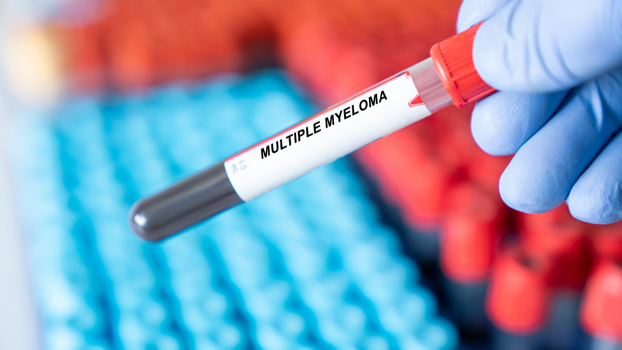 Multiple Myeloma. Multiple Myeloma disease blood test inmedical laboratory. Image Credit: Adobe Stock Images/luchschenF