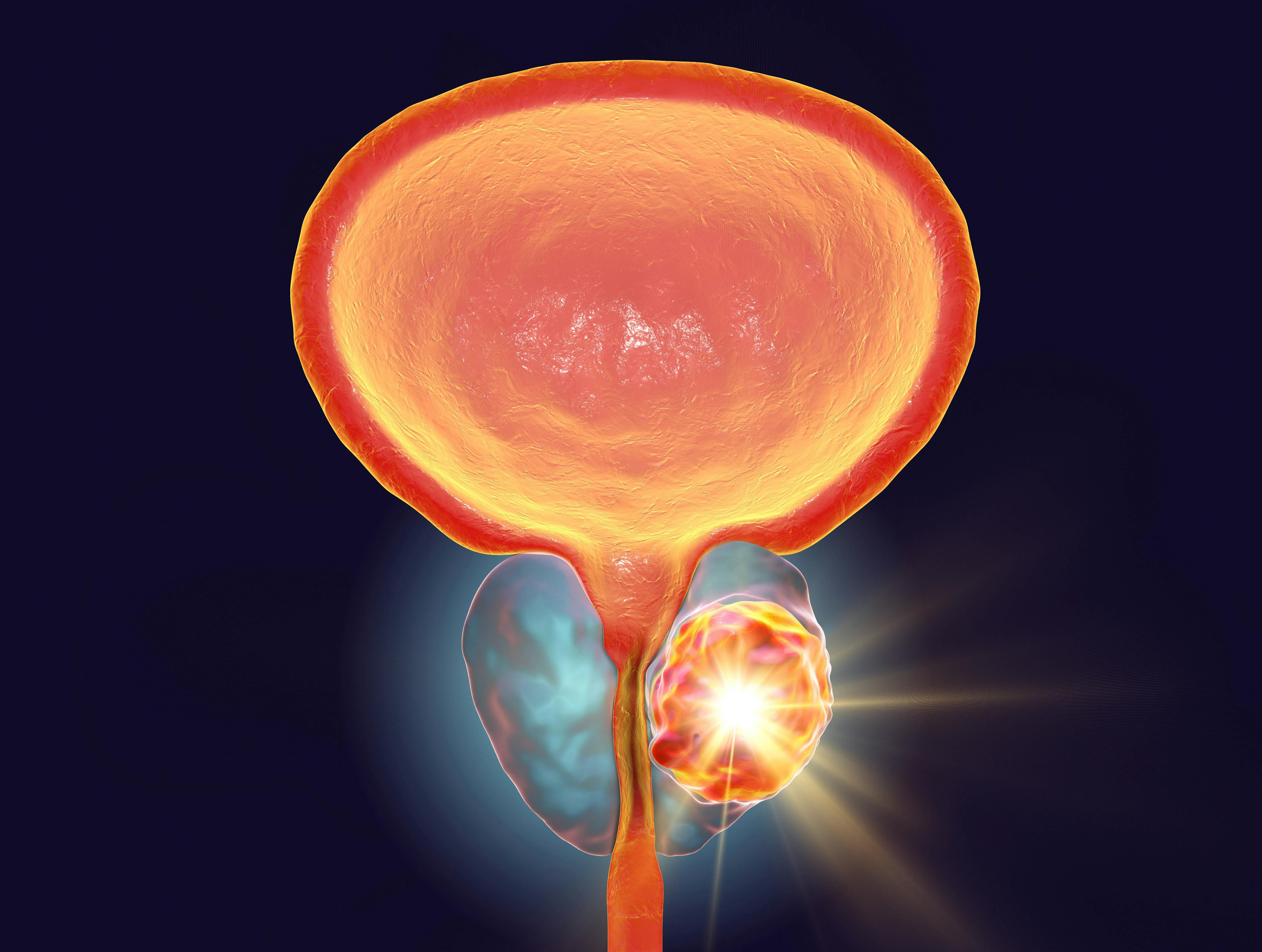 Image credit: Dr_Microbe | stock.adobe.com. Conceptual image for prostate cancer treatment, 3D illustration showing destruction of a tumor inside prostate gland