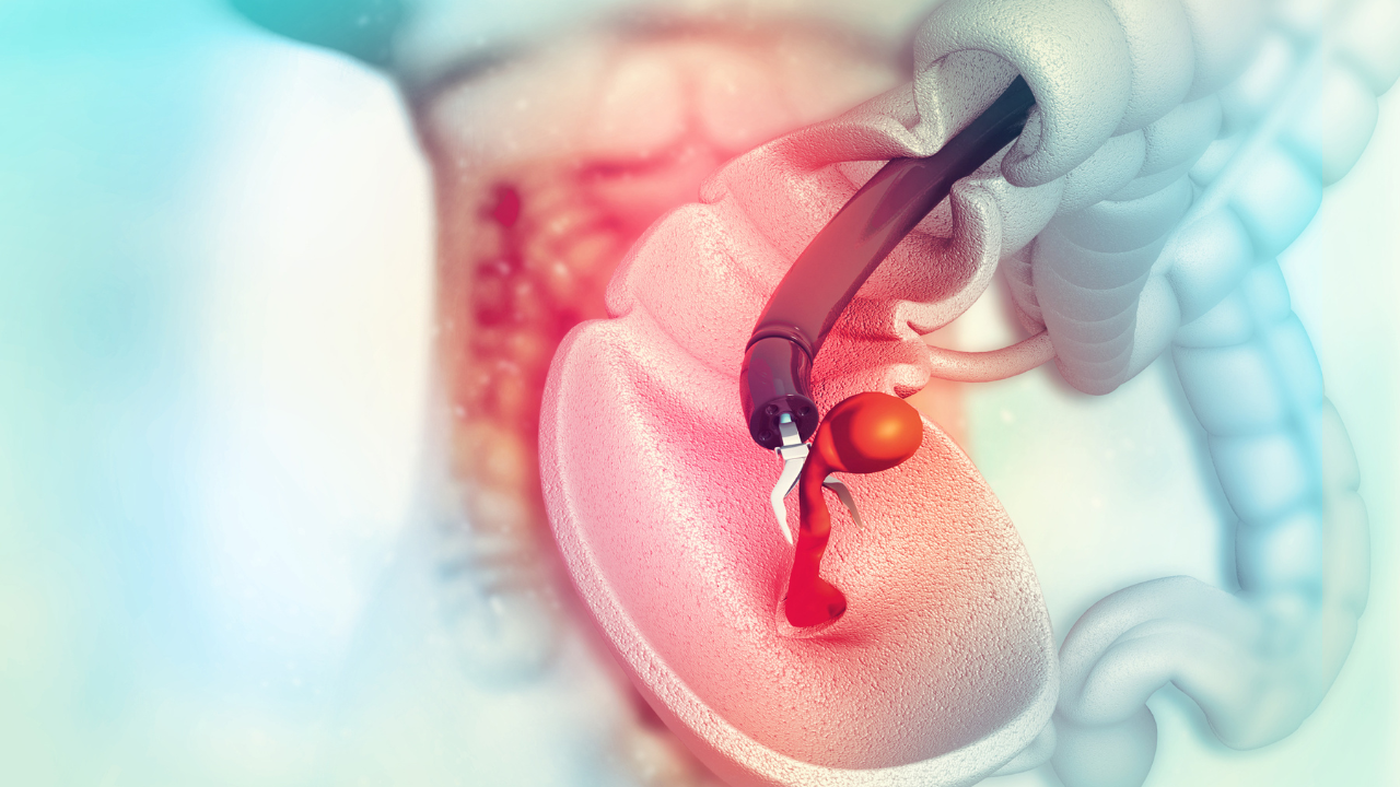 colon cancer. colonoscope in the colon. polyp removal. Image Credit: Adobe Stock Images/Crystal light