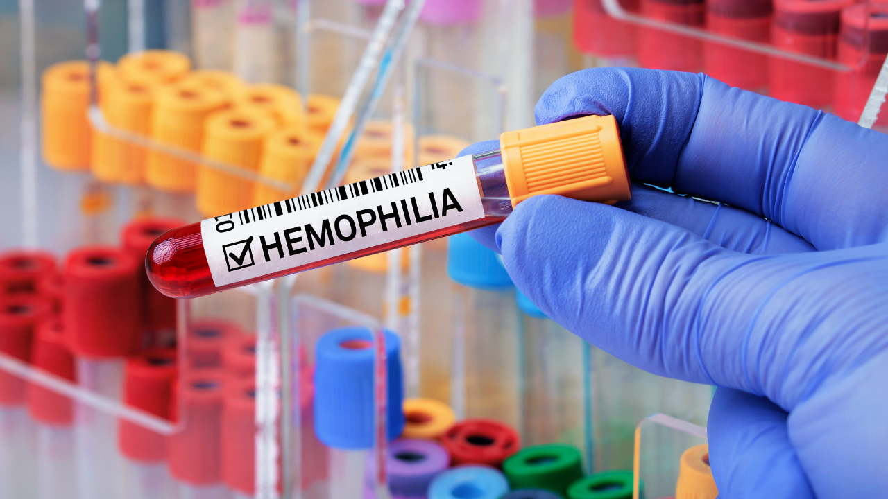 Blood sample with positive diagnosis of Hemophilia. Doctor holding Blood tube positive analysis to Haemophilia. Image Credit: Adobe Stock Images/angellodeco