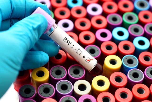 Image credit: jarun011 | stock.adobe.com. Blood sample positive with respiratory syncytial virus (RSV)