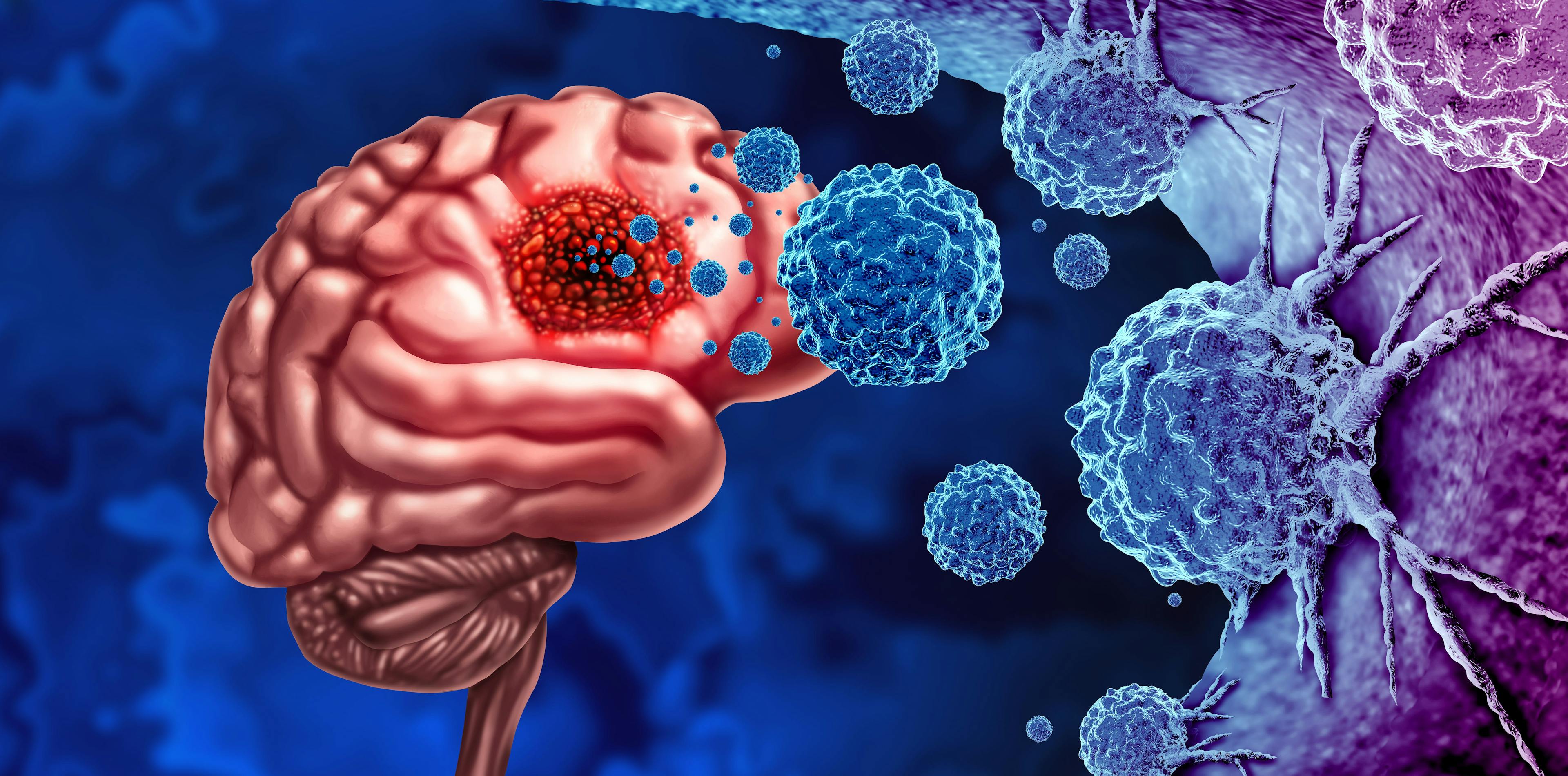 Glioma Cancer Tumor as malignant cells outbreak as a brain disease attacking neurons as a medical concept of neurological disease