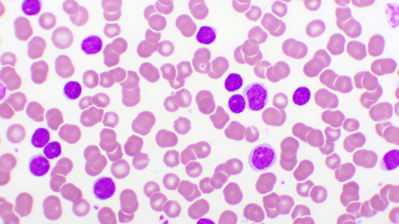 Blood picture of chronic lymphocytic leukemia or CLL, analyze by microscope, original magnification. Image Credit: Adobe Stock Images/jarun011