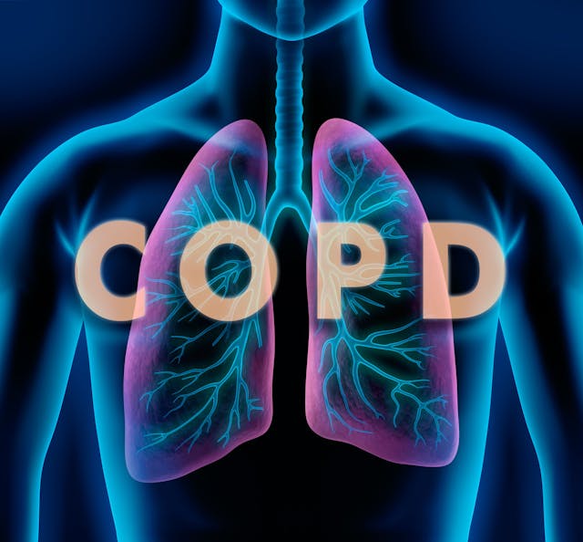 Image credit: peterschreiber.media | stock.adobe.com. Motiv COPD - Lunge und Bronchien