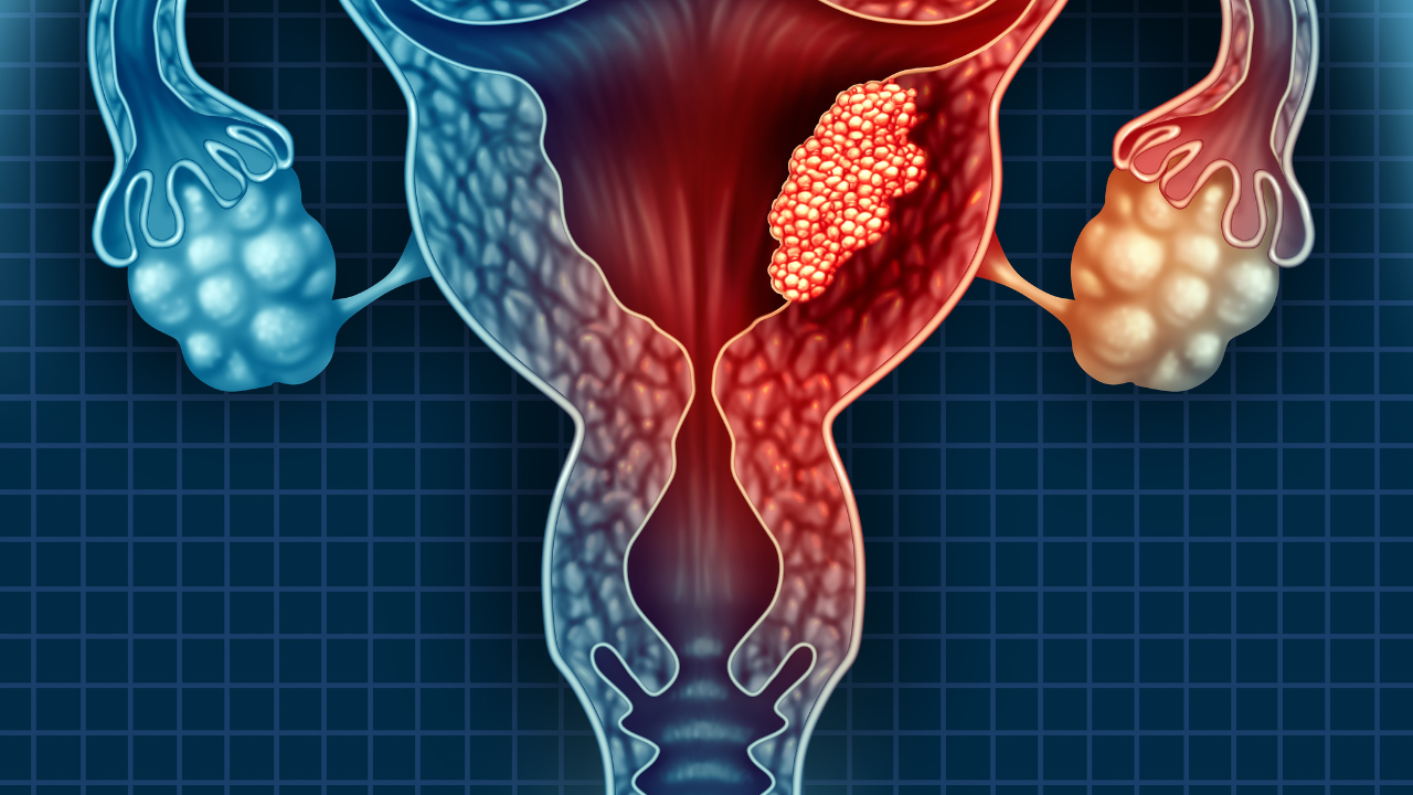 Uterus Cancer. Image Credit: Adobe Stock Images/freshidea