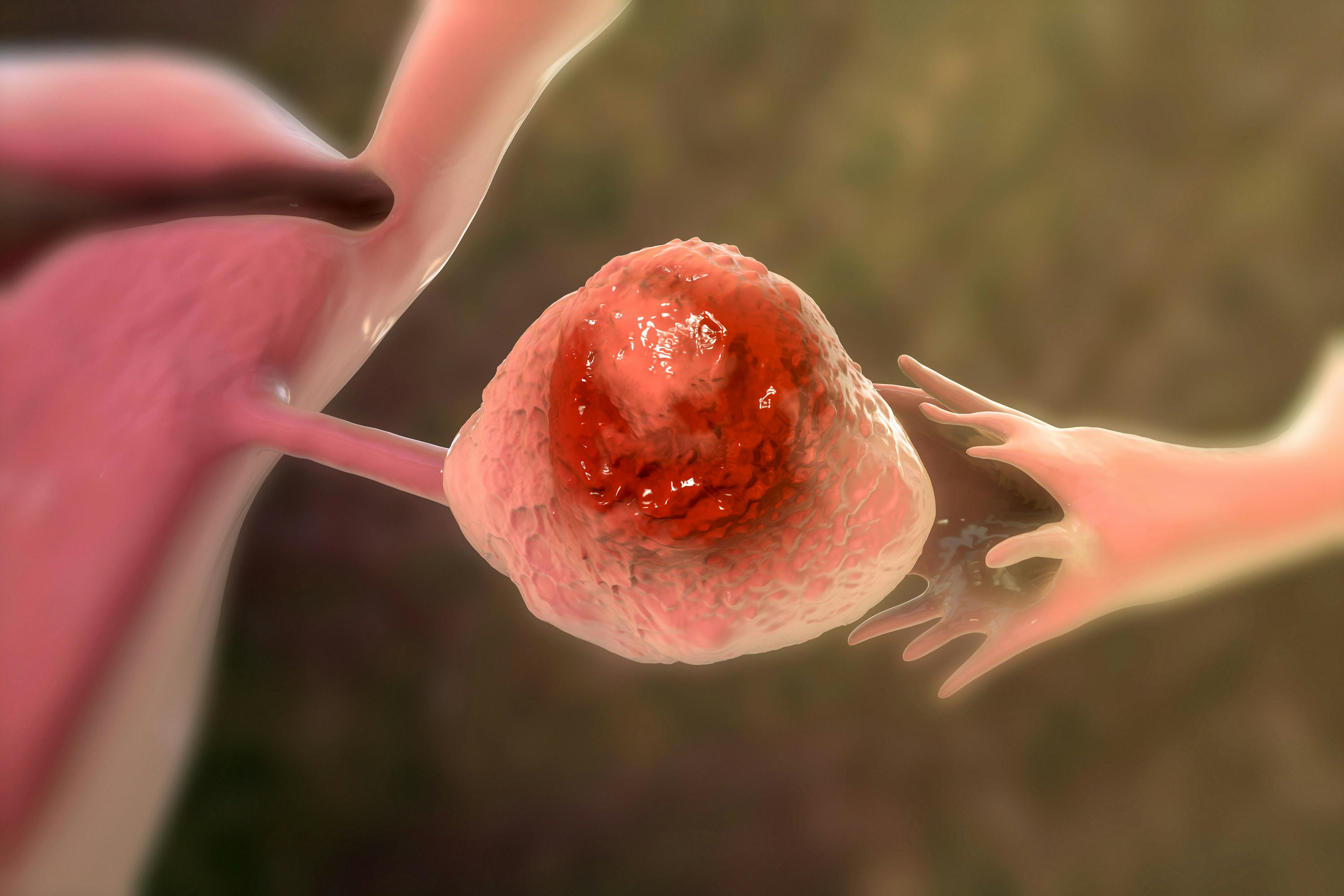 FDA Fast Tracks Antibody-Drug Conjugate for Ovarian, Fallopian Tube, Primary Peritoneal Cancers